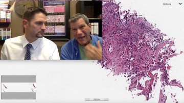 Pattern 5 – Nodules, Adenocarcinoma (Top 25 Pearls Series, Topic 2, Pearl 2)