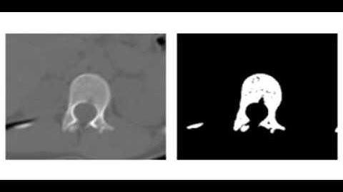 Automatic Segmentation of Medical Images Using Fuzzy C-Means
