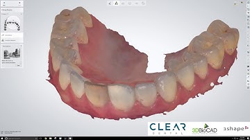 Positioning Guide to Reposition an Extracted Tooth