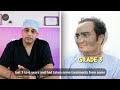 5 Months of Hair Transplant Results with Minoxidil Hair Regrowth