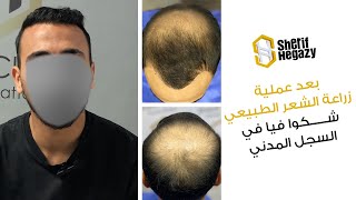 شكل عميلي بعد النتيجة النهائية بعد زراعة الشعر الطبيعيIIد.شريف حجازي