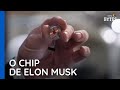 Neuralink: Implante de chip no crânio é aposta de Elon Musk