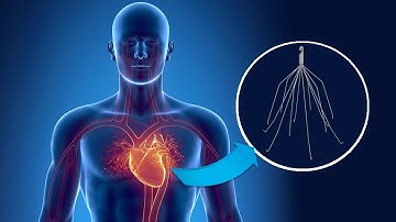 IVC Filter Lawsuits Arise From the High Failure Rate and Severe Injuries - The Ring Of Fire