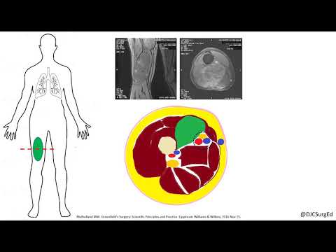 Soft Tissue Sarcoma