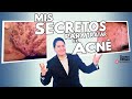 MIS SECRETOS PARA TRATAR EL ACNE || DR MARINO DERMATOLOGO