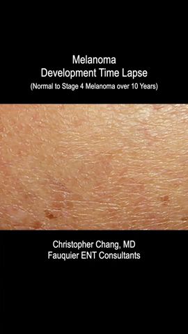 Melanoma Skin Cancer Development Time Lapse (Normal to Stage 4 Melanoma Over 10 Years)