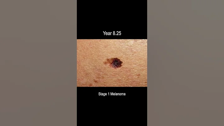 Melanoma Skin Cancer Development Time Lapse (Normal to Stage 4 Melanoma Over 10 Years) - DayDayNews