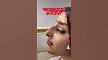 أجمل نتيجة تجميل الأنف في تركيا تجميل الانف تجميل الانف في تركيا تجميل انف 