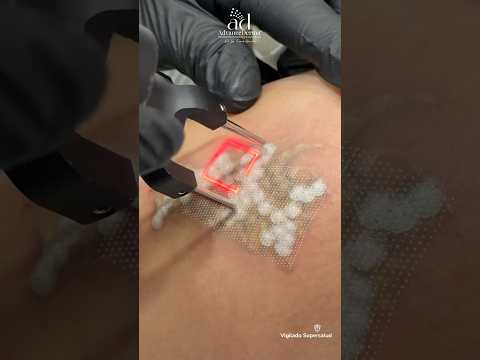 ¿Te hiciste un tatuaje y te arrepentiste?