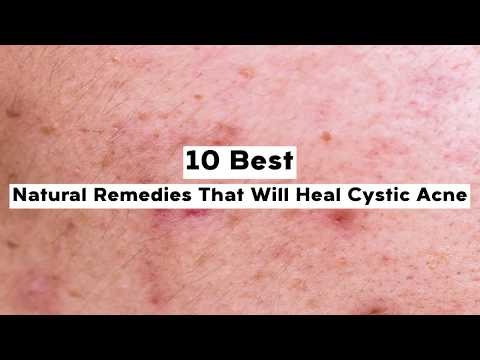  Best Natural Remedies That Will Heal Cystic Acne