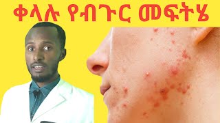 ቻዉ ቻዉ ብጉር በቀላሉ ለማጥፋት ፍቱን ተፈጥሮአዊ መፍትሄዎች/ Acne causes and treatments