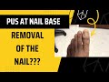Pus at nail base  removal of the nail