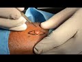 Giant Mole or Cyst Dermoid Removed With Plastic Surgery By Dr Sunil Richardson in India