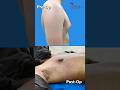 Gynecomastia result  grade 2a  removed fat and gland  gynecomastia surgery shorts