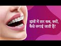 दांतों में तार कब, क्यों, कैसे लगाई जाती है और फायदे - Dental braces in hindi