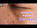 AMAZING WAYS TO GET RID OF SKIN WARTS | Skin Wart Removal Tips - Dr.Nischal K | Doctors' Circle