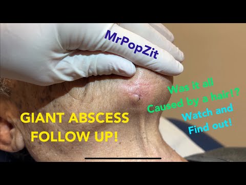 Giant chin abscess