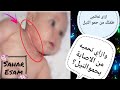 ما هي طرق علاج حمو النيل للأطفال الرضع وحديثي الولادة 