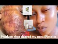 How i got rid of my stubborn pimplesacnedark spots fast permanently clear acnetheordinary