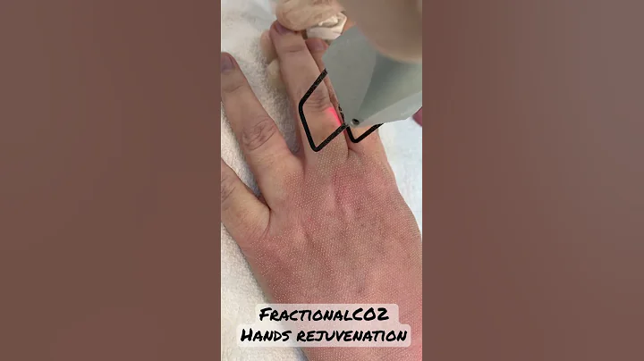 Hands rejuvenation by FractionalCO2 laser