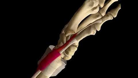 De Quervain Syndrome