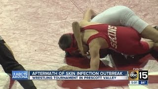 Aftermath of skin infection outbreak