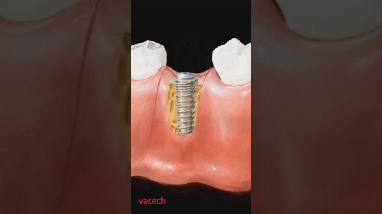 Установка имплантата на месте удаленного зуба😱 #vatech #стоматология #зубы #рентген #software