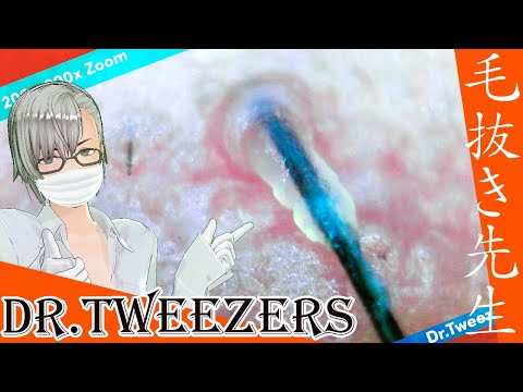 315 [200x Zoom] Your hair has this too Dr. tweezers 毛抜き先生の角栓や毛根