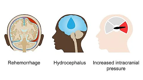 Managing hemorrhagic strokes–Neurology Masterclass