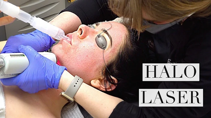 Halo-laserbehandling för acne-ärr: Nikki får ett nytt ansikte!