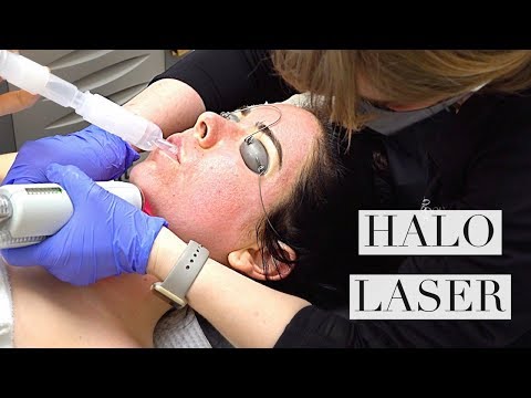 Halo Laser Treatment For Acne Scars: Nikki Gets A New Face!