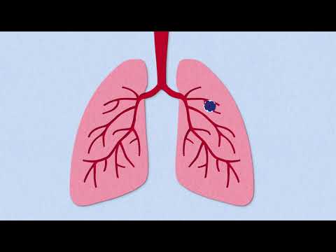 Video: Faktor Risiko Gaya Hidup Fibrosis Pulmonari Idiopatik