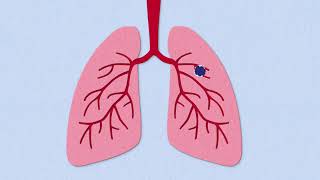 Fibrosis Explained