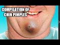 Chin zits  chin blackheads chin pimples and pimple pops