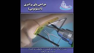 جراحی پای پرانتزی | متخصص ارتوپد | دکتر محمدابراهیم طاهریان | Braced foot surgery