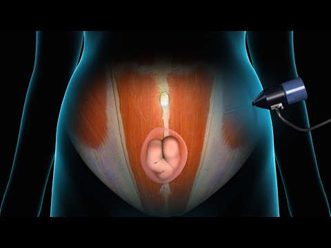 Laparoscopic Repair of Ventral Incisional Hernias