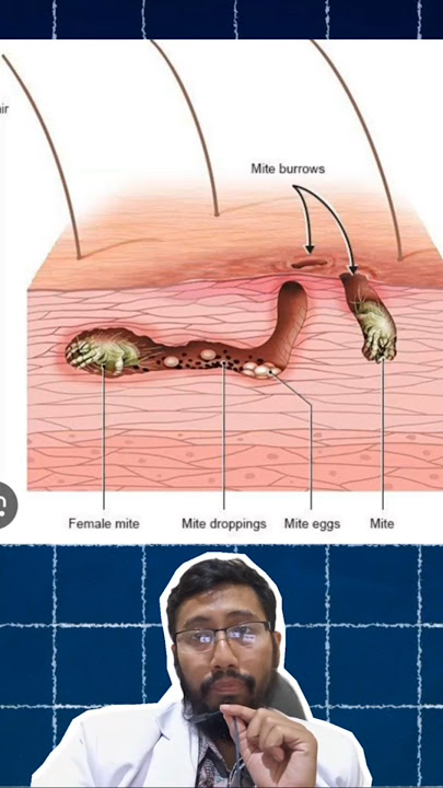 🦠 Parasit yang Menggali Kulitmu dan Bertelur di Dalam kulit: SCABIES! 🤯✨ #faktaunik #faktakesehatan