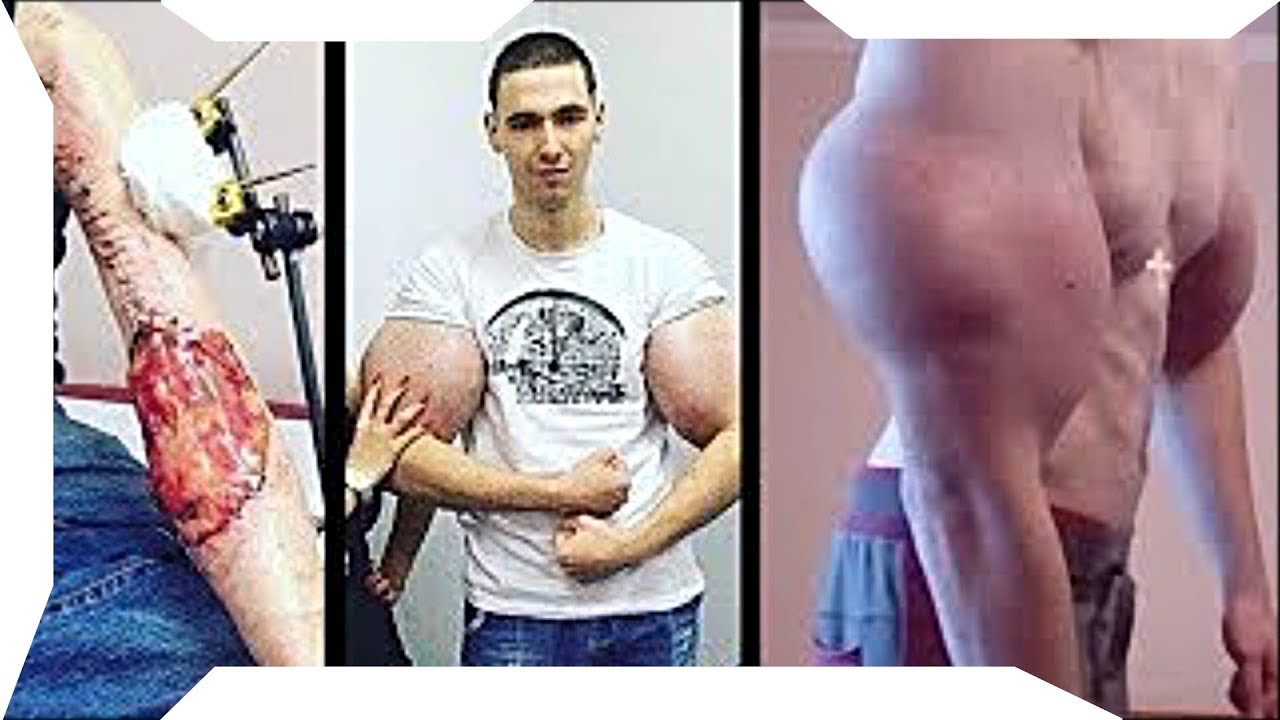 Russian Synthol Kid Arm Infection