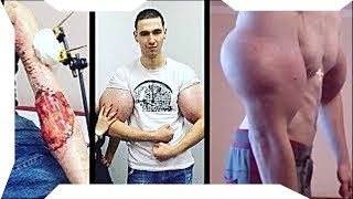 Russian Synthol Kid Arm Infection