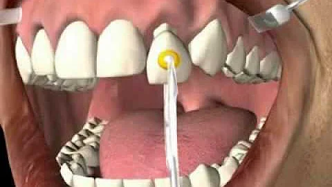 Wie bekommt man eine Zahnkrone wieder runter?