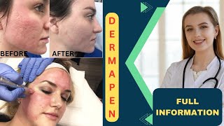 Microneedling Treatment For Acne Scars In Hindi | Dermaroller or DermaPen For Acne Scars