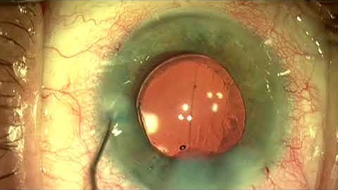 iStent Goniotomy by Steven G. Safran MD