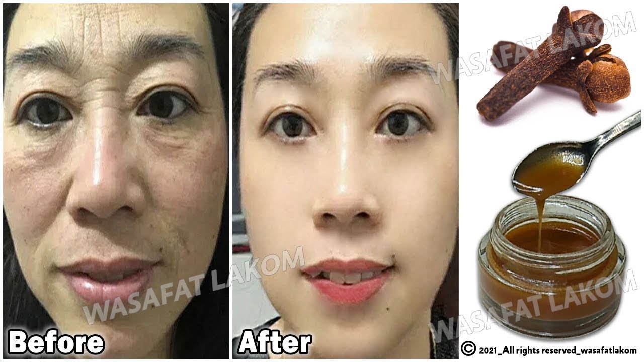 Say Goodbye to Wrinkles Discover the Power of Cloves for Youthful Skin