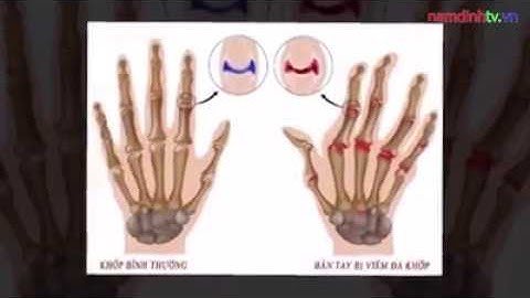 Đau nhức xương khớp khỏi hoàn toàn chỉ sau 3 tháng