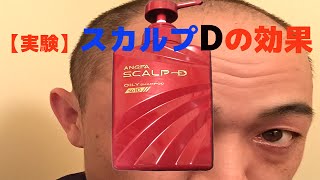 【実験】スカルプDはハゲでも効果があるのか⁉︎4ヶ月目