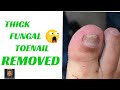 Total Toenail Removal Before &amp; After