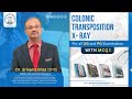 Colonic Transposition X- Ray by Dr. SRB | Dr. Srirama Bhat
