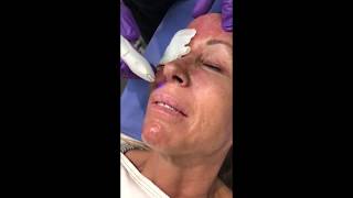Portrait Plasma Skin Resurfacing by Dr. Steven Svehlak MD FACS