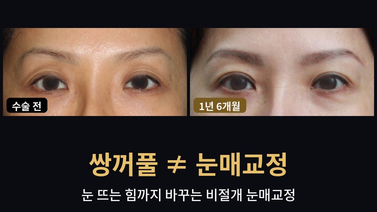 중년에도 비절개 눈매교정이 될까? | 49세, 결막 쪽 눈매교정 1년 6개월#비절개눈매교정 #중년눈매교정 #결막눈매교정 #안검하수 #졸린눈 #연세자연미 #신촌성형외과