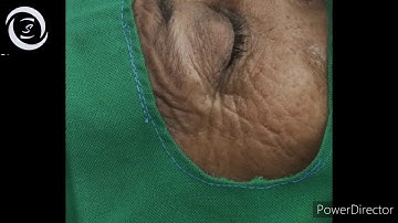 How to perform the van lint